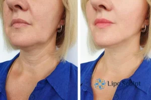 Double chin before and after Hi-Fu treatment 4 Book your double chin treatment Liverpool today! We are here to help!
