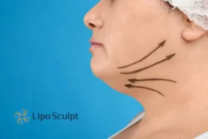 Double chin before and after Hi-Fu treatment 3 Boost your confidence with a Double chin treatment Liverpool