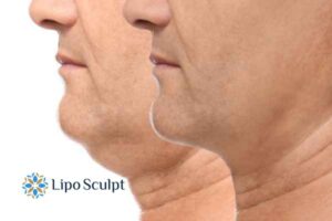 Double chin before and after Hi-Fu treatment 2 Double chin treatment Liverpool from Lipo Sculpt - feel more confident today!