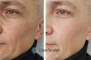 How to Fight Aging Symptoms 3 Fight Aging Symptoms Liverpool With HIFU and Morpheus8 Today!