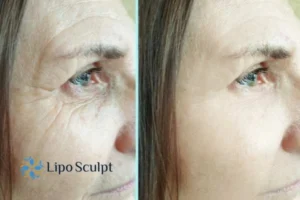 How to Fight Aging Symptoms 2 Do you want to Fight Aging Symptoms Liverpool? Contact Lipo Sculpt today!