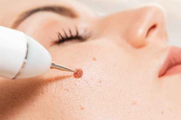 CryoPen: 5 Skin Concerns It May Be Used to Treat 3 What actually happens during a CryoPen treatment Liverpool?