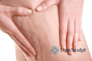 CoolSculpting for Legs: The Innovative Approach to Redefining Your Legs 5 Start your journey today book your coolsculpting treatment Liverpool online today!